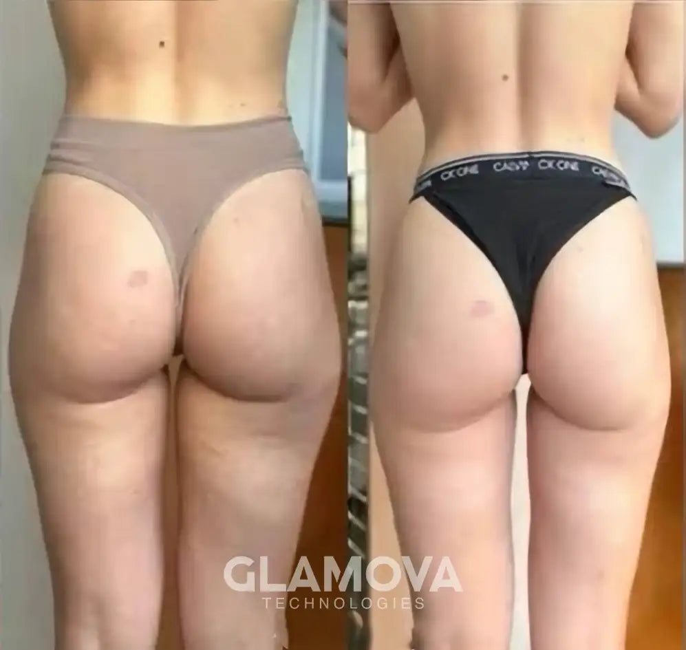 From Self-Conscious to Confident: How Glamova™ Massager Transformed My Skin