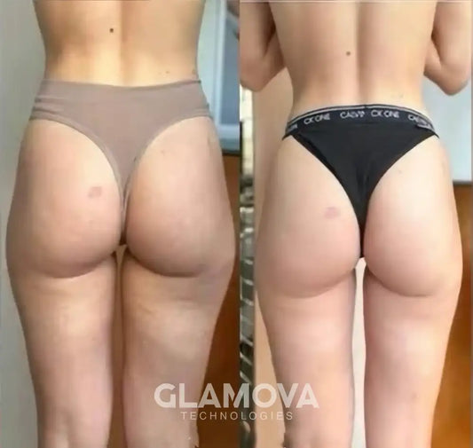 From Self-Conscious to Confident: How Glamova™ Massager Transformed My Skin
