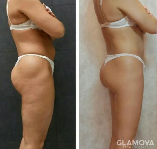 Quick Results, Smoother Skin: My Glamova Anti-Cellulite Journey